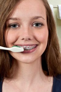 Brushing your new braces a minimum of 4 times a day is advised