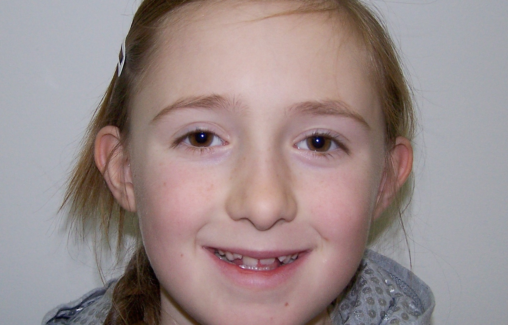 Young patient requiring orthodontic treatment at Smile101