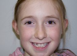 Young patient requiring orthodontic treatment at Smile101