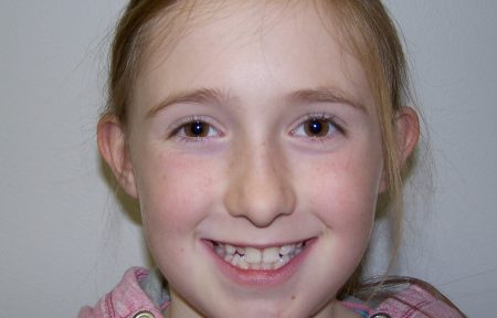 Young patient requiring orthodontic treatment at Smile101