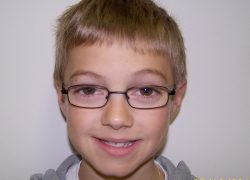 Young patient requiring orthodontic treatment at Smile101