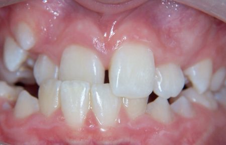 Young patient requiring orthodontic treatment at Smile101