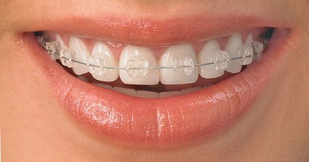 ceramic braces adult orthodontic treatments