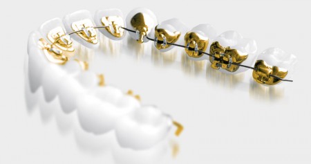 lingual braces adult orthodontic treatments