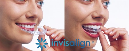 Invisalign clear trays