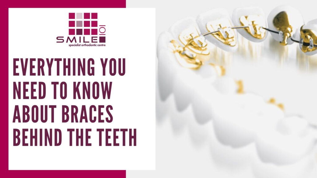 Everything you need to know about braces behind the teeth